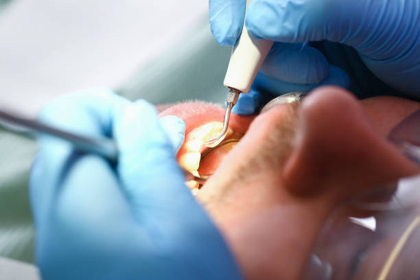 Best Chipped Tooth Repair Near Me  in Mcloud, OK