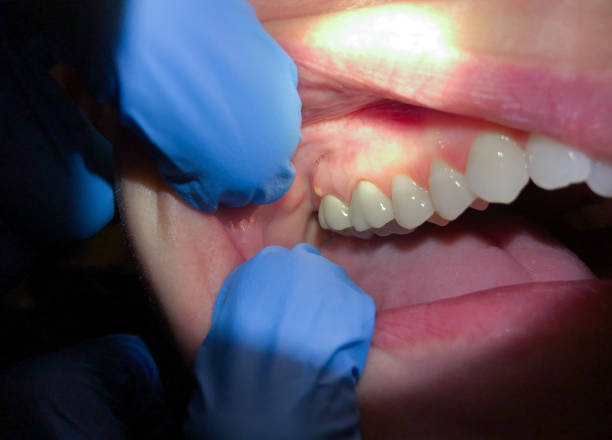 Best Root Canal Emergency Dentist  in Mcloud, OK